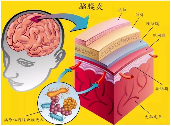 吃出来的脑膜炎,竟是